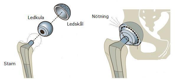 Sida 2 (10) Den nya höftleden Operation: Vid en höftledsplastik ersätts den sjuka leden med en protes som består av ett metallskaft med ledkula och ledskål.