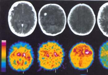 PET-kamera ( 18F-FDG positron emission tomography) visar att hypermetabolism i hjärnan föregår