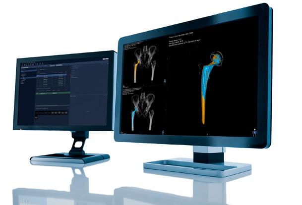 VERKSAMHETSOMRÅDE BUSINESS INNOVATION 31 Hårdare krav på implantatindustrin ökar behovet av kliniska studier Analystjänsten Sectra CTMA (CT-based Micromotion Analysis) förenklar processen vid klinisk