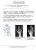 Instruktioner för dig som genomgår rehabilitering efter fingerledens steloperation