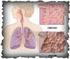KOL - Kroniskt Obstruktiv Lungsjukdom