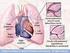 Pulmonary hypertension (PH) and congestive heart failure (CHF)