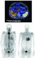 Immunoglobulin light chain (AL) amyloidosis (previously referred to as primary amyloidosis) Systemisk sjukdom