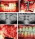 Förlust av tänder leder i varierande grad till nedbrytning av