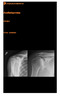 Axelledsprotes. Allmänt. Artros i axelleden /PÖ