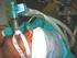 Endotracheal tube size and Sore Throat following surgery A randomized, controlled study
