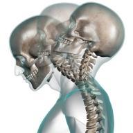 Kan whiplashvåld ge hjärnskador. NRH-s seminarium i Mölndal 181101 5(7) Bild 13 Så, kan whiplashtrauma orsaka hjärnskada?