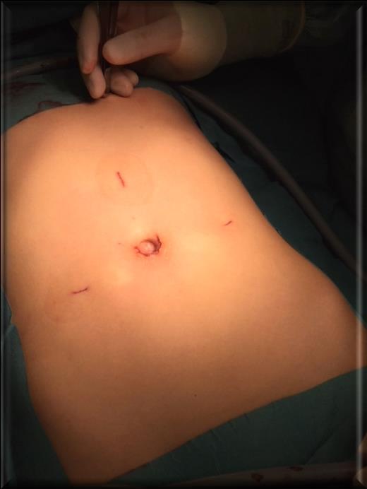 Laparoskopisk splenektomi Patienten i ryggläge. Öppen portsättning o Hassontroakar. Övriga 5 mm portar se foto.