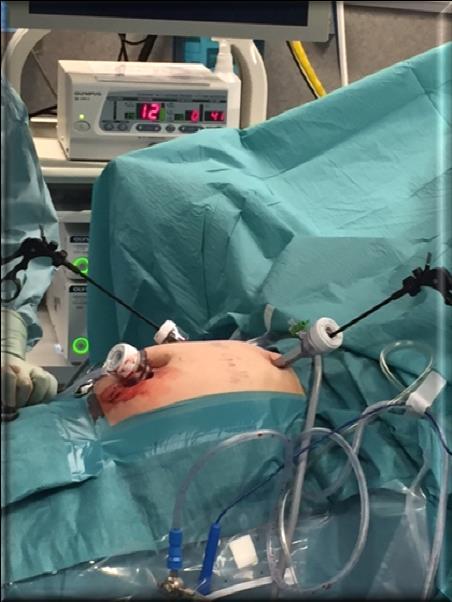 Lapgalla med ERCP RV Instrumentuppsättningen är identiskt med den vi använder vid USÖ/Lindesberg.