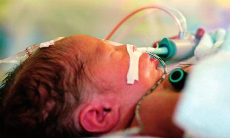Den grupp av de mycket för tidigt födda barnen som utvecklar kronisk neonatal lungsjukdom drabbas ofta av infektionsutlöst astma under de första levnadsåren och nedsättning i lungfunktionen under