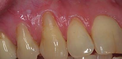 Patienterna upplevde förbättring av symtom när tandfyllningsmaterialen avlägsnats men orsaken till förbättringen är oklar.