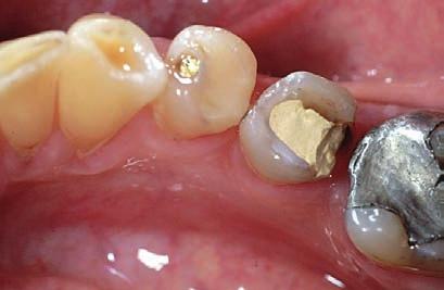 Polymerisationskrympning och genererad spänning ska givetvis vägas mot andra mekaniska, fysikaliska och kliniska egenskaper i det slutliga materialvalet av dental komposit.