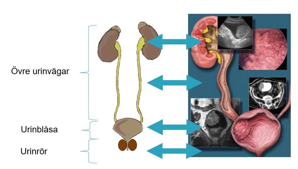 UNDERLAG TILL REGIONAL CANCERPLAN FÖR UROTELIAL CANCER; URINBLÅSECANCER OCH UROTELIAL CANCER I ÖVRE URINVÄGARNA (UTUC) I NORRA SJUKVÅRDSREGIONEN FÖR ÅREN 2019-2021 BAKGRUND Urotelial cancer är en