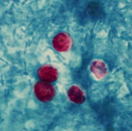 Cryptosporidium species Intracellulär parasit som orsakar vattniga diarréer och buksmärtor. Immunsupprimerade individer kan få kroniska symtom med livshotande diarré. C. parvum och C.