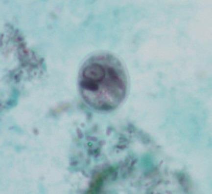 Entamoeba histolytica Orsakar invasiv amoebiasis: intestinal och extraintestinal (främst i levern).