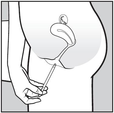 2. För försiktigt in applikatorn i vagina.