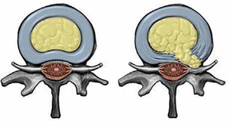 Boxer & Hälsa SPONDYLOS SPONDYLOS OCH DISH HOS BOXER KLUBBENS NYA KRAV INTERVJU MED VÅR AVLÄSARE OLIKA METODER GER OLIKA RESULTAT AVELSFRÅGAN FYSIOTERAPEUTISK BEHANDLING AV SPONDYLOS MILTON HITTADE