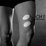 till vastus lateralis.