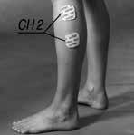 CEFAR REHAB X2: 18. 203 UNDERBENET NEDSATT DORSALFLEXION OCH -PRONATION 1. Nedsatt dorsalflexi