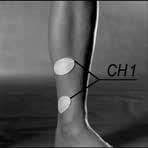 Placera ett elektrodpar över tibialis anterior och ett par över gastrocnemius.