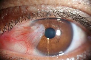 1.4.2 Behandling Om pterygium växer så mycket så det stör synaxeln kan det opereras.