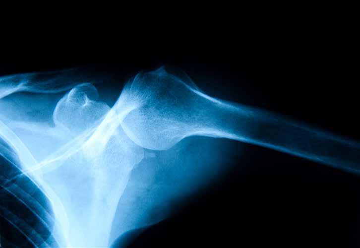 Foto: istockphoto Primär och sekundär osteoporos - profylax viktigt för riskgrupperna Primär osteoporos är ovanligt hos barn.