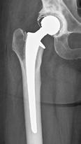 6 7 Höftprotes På Kungälvs sjukhus använder vi endast ledproteser som är väl beprövade.