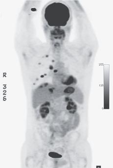 Det kommer mera Bra respons för behandlingar mot ovanliga mutationer ROS1 (crizotinib) BRAF