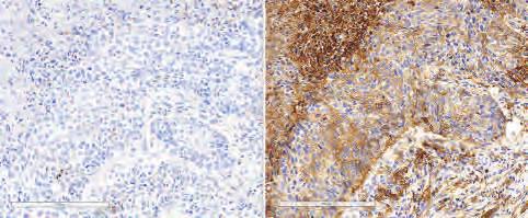 88 A ITT population 1 62 34 32 1 9 5 Atezolizumab Overall survival (%) Number at risk Pembrolizumab 2 mg/kg Pembrolizumab 1 mg/kg Docetaxel A 1 9 8 7 6 5 4 3 2 1 B 139 151 152 Pembrolizumab 5 11 115