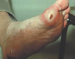 Diabetesfotsår Infektion i foten vid diabetes är ett extremitetshotande tillstånd som kräver skyndsam handläggning.