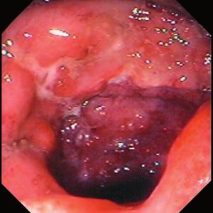 Crohns sjukdom Vid inflammatoriska tarmsjukdomar som Crohns sjukdom och ulcerös kolit överreagerar kroppens eget immunförsvar och orsakar en kronisk inflammation i tarmslemhinnan.