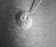 Tuberkulinet injiceras intrakutant på underarmen. När injektionen utförs korrekt bildas en rund vit kvaddel som försvinner efter en stund (Fig 1b).