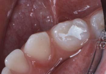 Emalj och dentin är