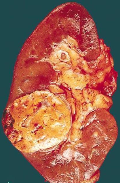 Kvalitetsproblem om antalet obduktioner minskar Försämrad statistik av cancerdiagnoser