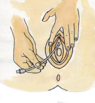 Självkaterisering av Gepan Instill Självkaterisering av Gepan instill för kvinnor 1 Ta tid på dig! Tvätta händerna med tvål och vatten och se till att du har spruta och kateter inom räckhåll.