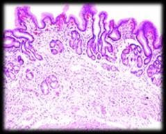 Atrophic Gastritis