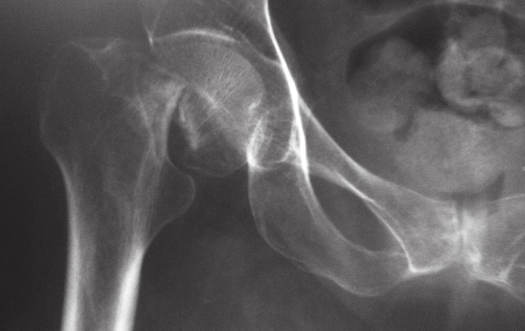 osteoporos 1
