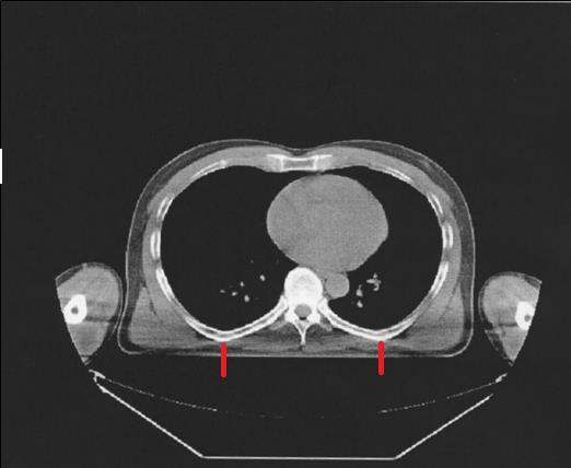 An in-vivo dosimetry system is used to monitor the delivered dose to the patient each fraction. In Gothenburg, diodes are used, and their places are shown in Figure 5.