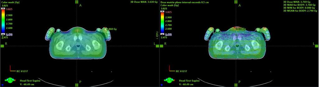 for example, the lungs, stomach and shoulders, as shown in Figure 23. The dose distributions calculated by Eclipse and Monte Carlo are shown to the left and right respectively.