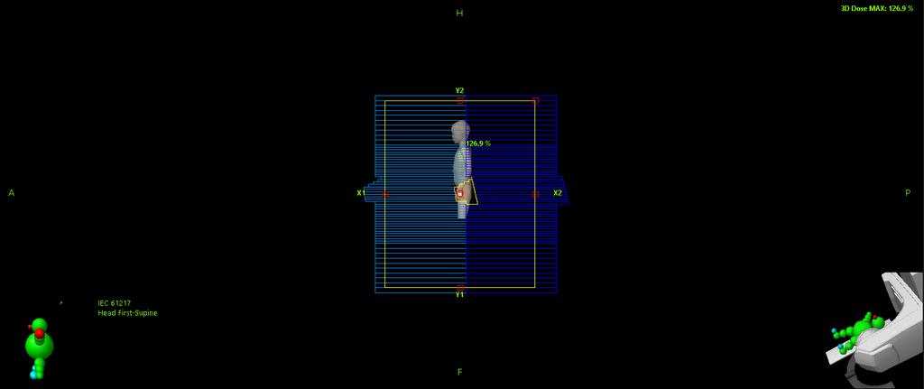 Table 8. DVH parameters for the total body (1) and lungs (2) calculated with Eclipse and Monte Carlo simulations. Doses are presented in Gy.