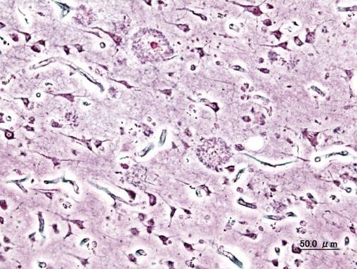 Ytterligare patologi vid Lewy body sjukdom Många Lewy