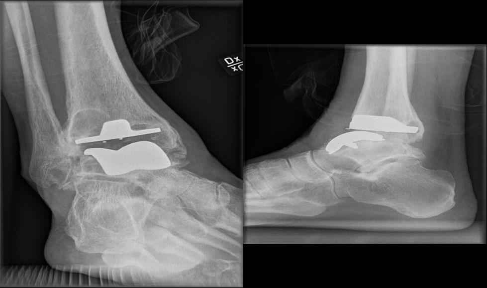 Speciella fall Det finns några patienter som har artros i båda fotlederna. Här rekommenderas steloperation i enbart ena sidan och fotledsprotes på den andra sidan.