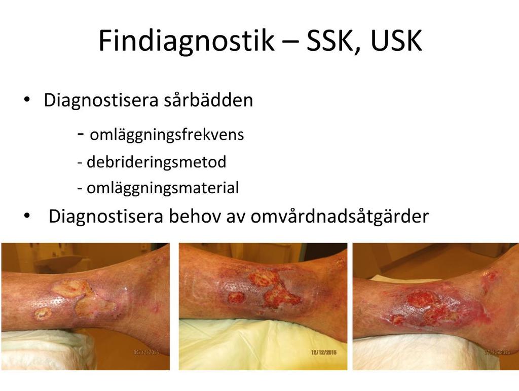 Gemensam handläggning Diagnos Grovdiagnostik Findiagnostik Benödem Ordinera kompression Anpassa kompression Sårsmärta
