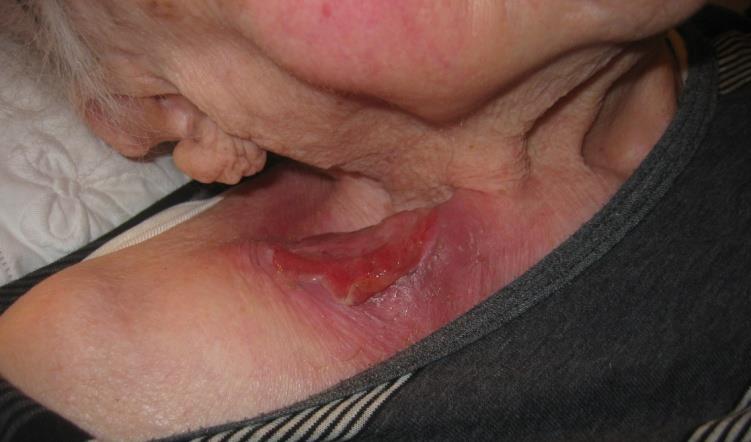 Läkningstiderna skiljer sig åt, längst tid tar de arteriella såren att läka.