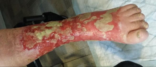 Patientfall Blandsår (arteriell och venös
