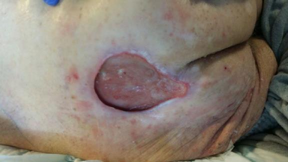 hem med 2 Sacrum