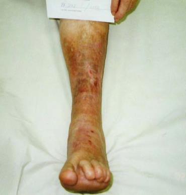 595 000 kr Korrekt behandling på samma patient, se nästa bild B-M