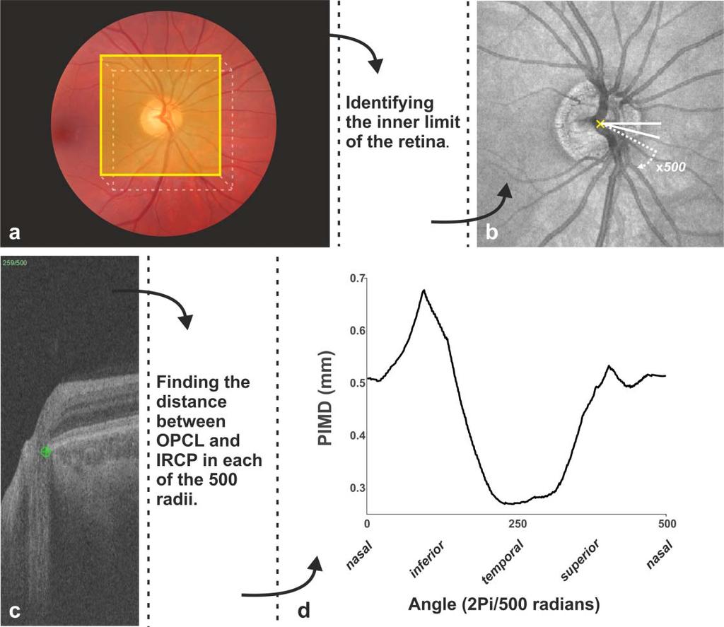11 (23) marked OPLCs outline the delineation of the ONH central limit of the pigment epithelium. The location of the delineation was then reintroduced into the Cartesian coordinate system.