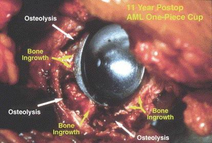 Fig. 1. Osteolysis surrounding a well fixed cementless AML monoblock acetabular component. Scott M. Sporer, Wayne G.