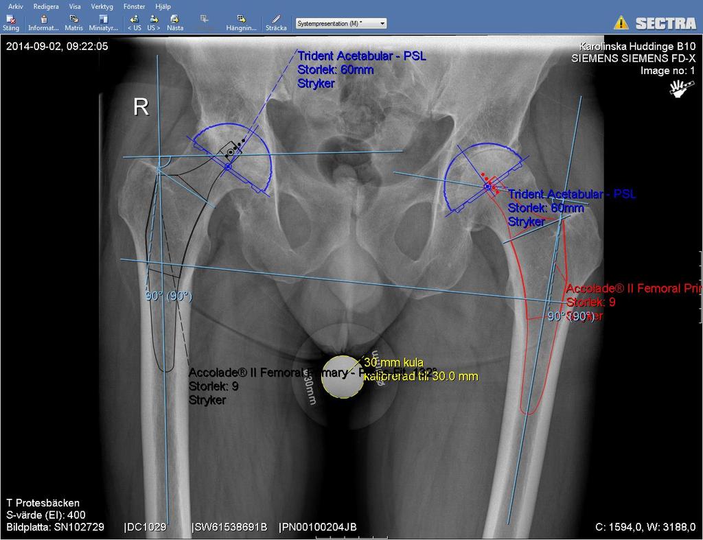 Preop